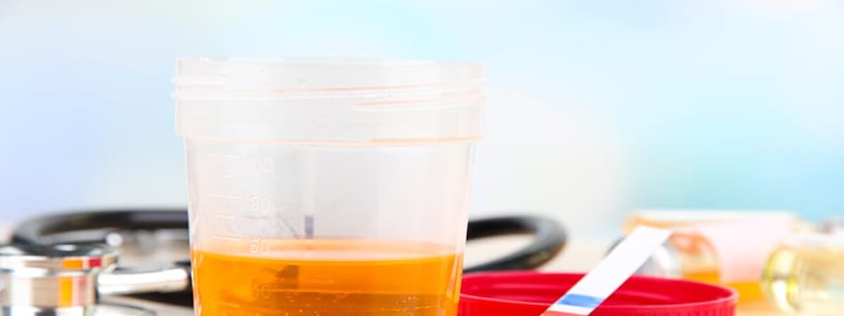 How Accurate Are Urine Drug Tests?