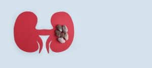 Kidney Stones